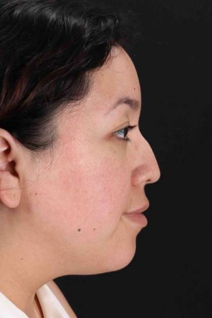 Rhinoplasty Before & After Patient #3060