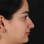 Rhinoplasty Before & After Patient #3071