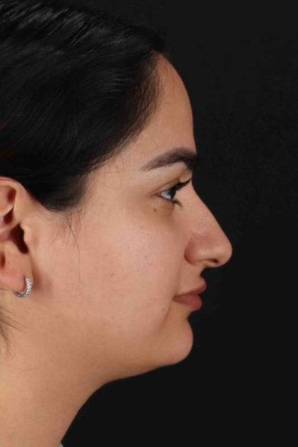 Rhinoplasty Before & After Patient #3071