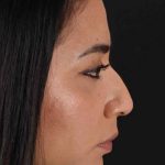 Rhinoplasty Before & After Patient #3082