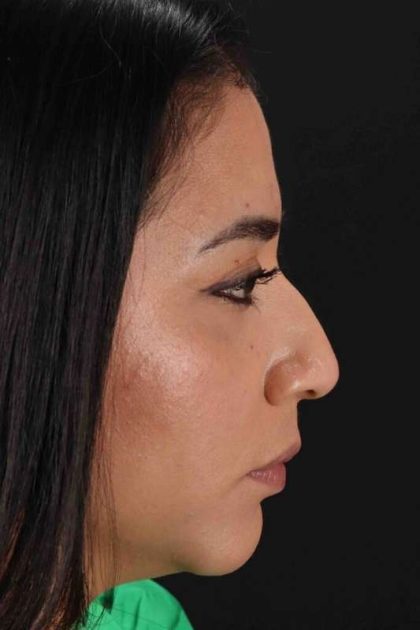 Rhinoplasty Before & After Patient #3082