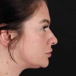 Rhinoplasty Before & After Patient #3093