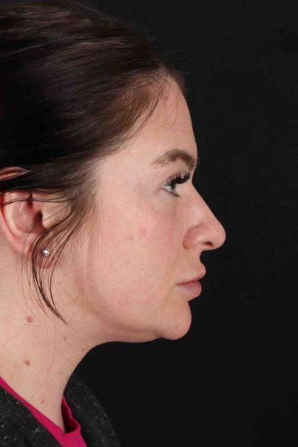 Rhinoplasty Before & After Patient #3093