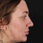 Rhinoplasty Before & After Patient #3104