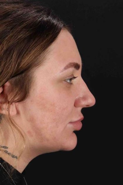 Rhinoplasty Before & After Patient #3104