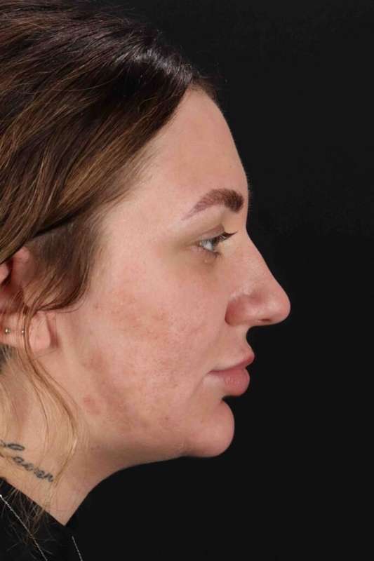 Rhinoplasty Before & After Patient #3104