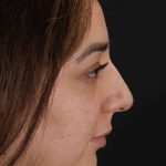 Rhinoplasty Before & After Patient #3115