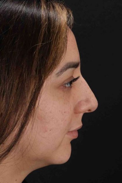 Rhinoplasty Before & After Patient #3115