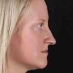 Rhinoplasty Before & After Patient #3126
