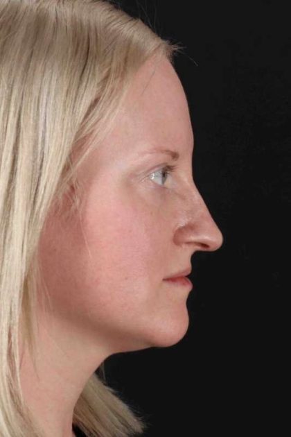 Rhinoplasty Before & After Patient #3126