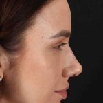 Rhinoplasty Before & After Patient #3137