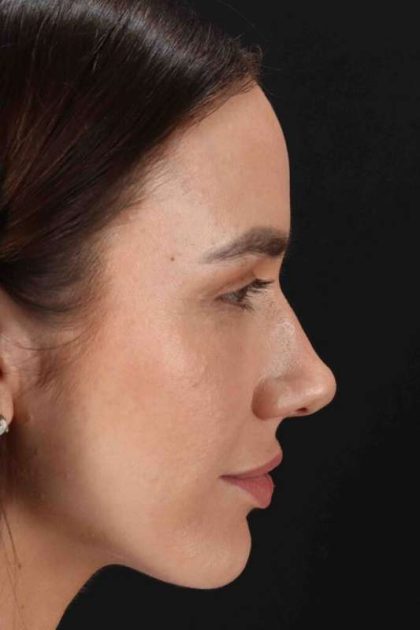 Rhinoplasty Before & After Patient #3137