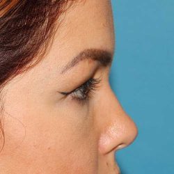 Browlift Before & After Patient #1384