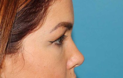 Browlift Before & After Patient #1384
