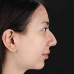 Rhinoplasty Before & After Patient #3159
