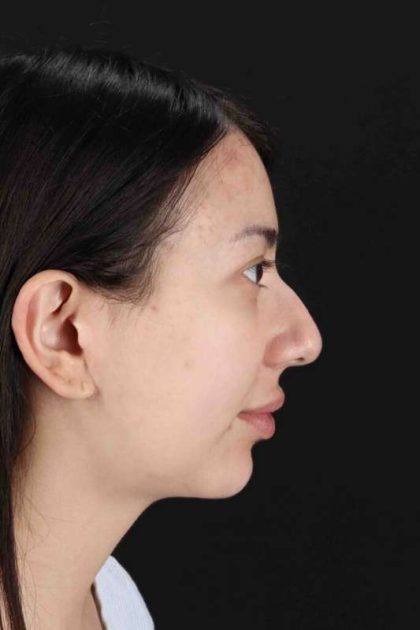 Rhinoplasty Before & After Patient #3159