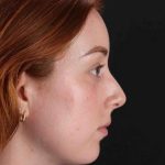 Rhinoplasty Before & After Patient #3170