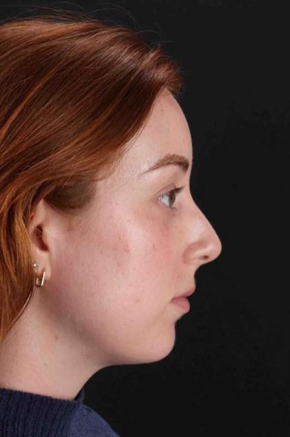 Rhinoplasty Before & After Patient #3170