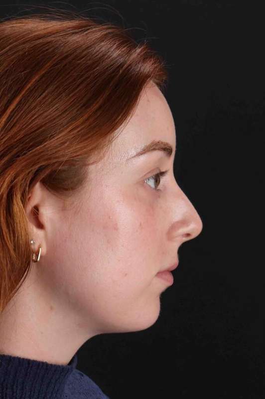 Rhinoplasty Before & After Patient #3170