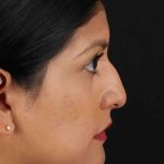 Rhinoplasty Before & After Patient #3181