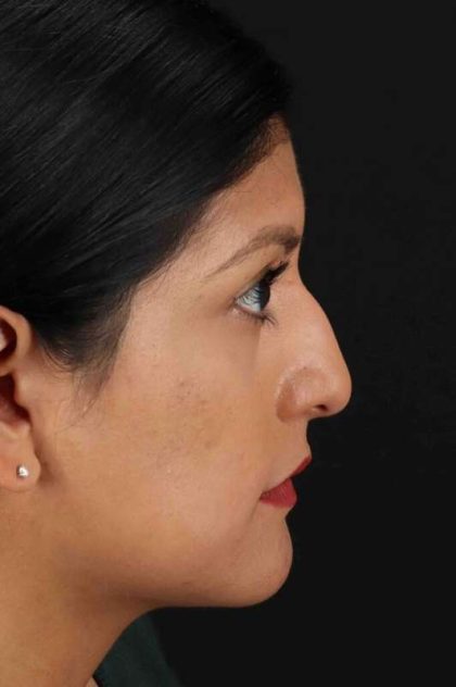 Rhinoplasty Before & After Patient #3181