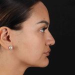 Rhinoplasty Before & After Patient #3192