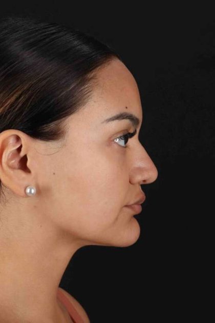 Rhinoplasty Before & After Patient #3192