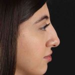 Rhinoplasty Before & After Patient #3214
