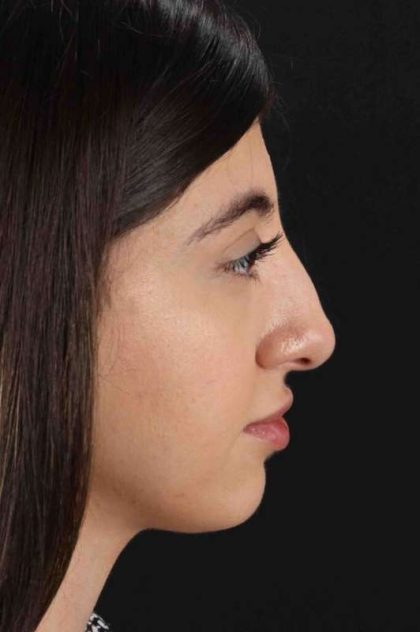 Rhinoplasty Before & After Patient #3214
