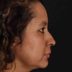 Rhinoplasty Before & After Patient #3225