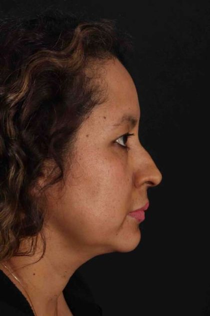 Rhinoplasty Before & After Patient #3225
