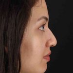 Rhinoplasty Before & After Patient #3236