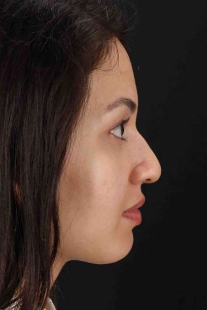 Rhinoplasty Before & After Patient #3236