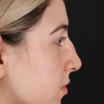 Rhinoplasty Before & After Patient #3247