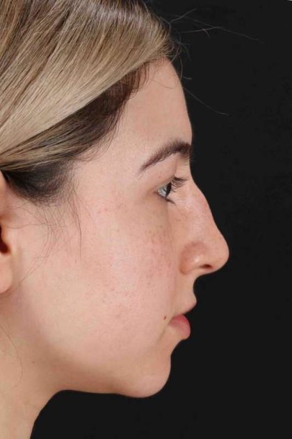 Rhinoplasty Before & After Patient #3247