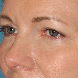 Browlift Before & After Patient #1391