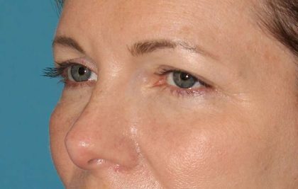 Browlift Before & After Patient #1391
