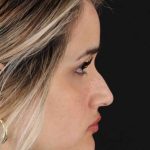 Rhinoplasty Before & After Patient #3258