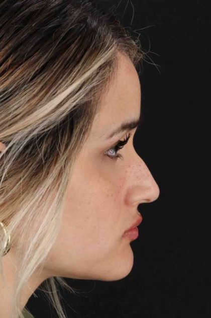 Rhinoplasty Before & After Patient #3258