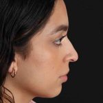 Rhinoplasty Before & After Patient #3269