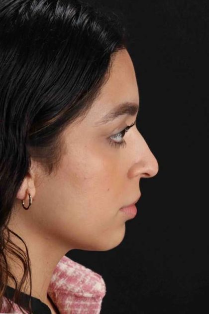 Rhinoplasty Before & After Patient #3269