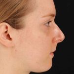 Rhinoplasty Before & After Patient #3280