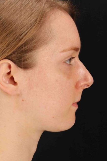 Rhinoplasty Before & After Patient #3280