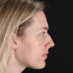 Rhinoplasty Before & After Patient #3291