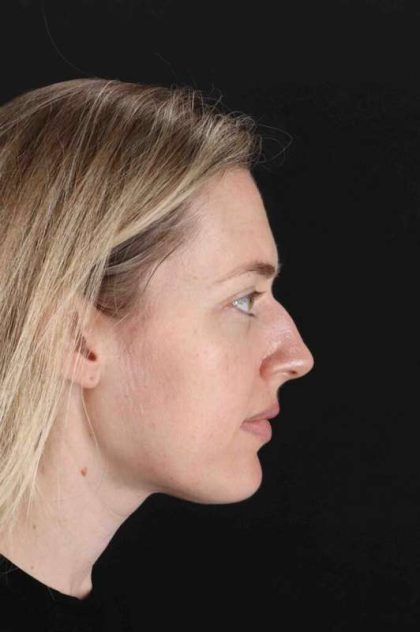 Rhinoplasty Before & After Patient #3291