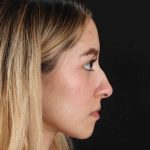 Rhinoplasty Before & After Patient #3302