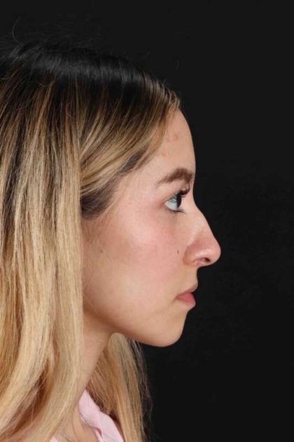 Rhinoplasty Before & After Patient #3302