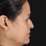 Rhinoplasty Before & After Patient #3313