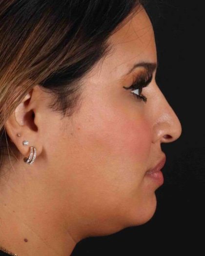 Rhinoplasty Before & After Patient #3324