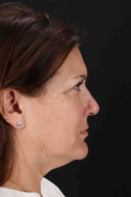 Co2 Laser Before & After Patient #3357
